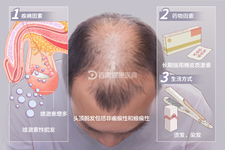 冬季降温，脂溢性脱发有哪些表现？该怎么预防？