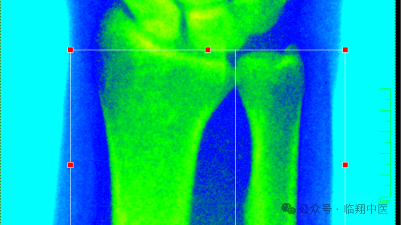 双能x骨密度检测仪为什么非得输入体重身高给骨骼做个“体检”—双能X线骨密度检测，让骨质疏松无所遁形！_https://www.jmylbn.com_新闻资讯_第5张