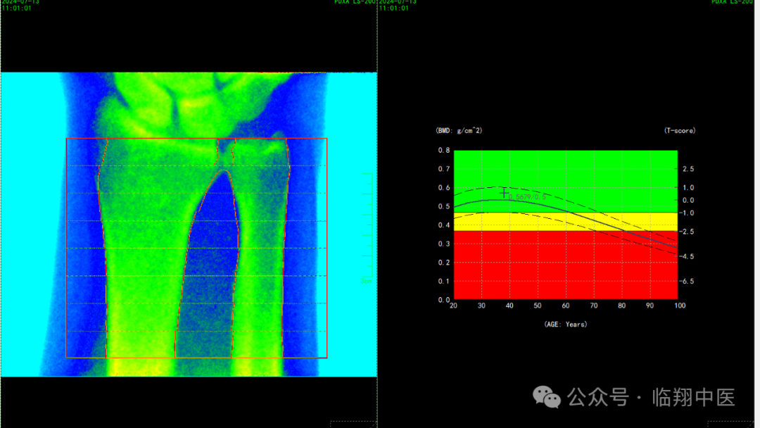 双能x骨密度检测仪为什么非得输入体重身高给骨骼做个“体检”—双能X线骨密度检测，让骨质疏松无所遁形！_https://www.jmylbn.com_新闻资讯_第4张