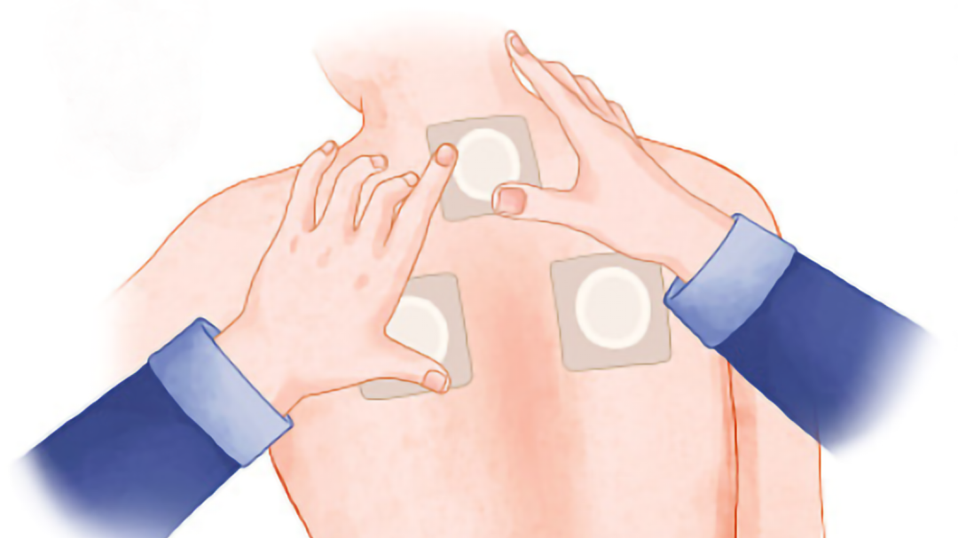 趁熱養(yǎng)生，祛寒濕固根本！臨滄市中醫(yī)醫(yī)院三伏貼開貼啦！