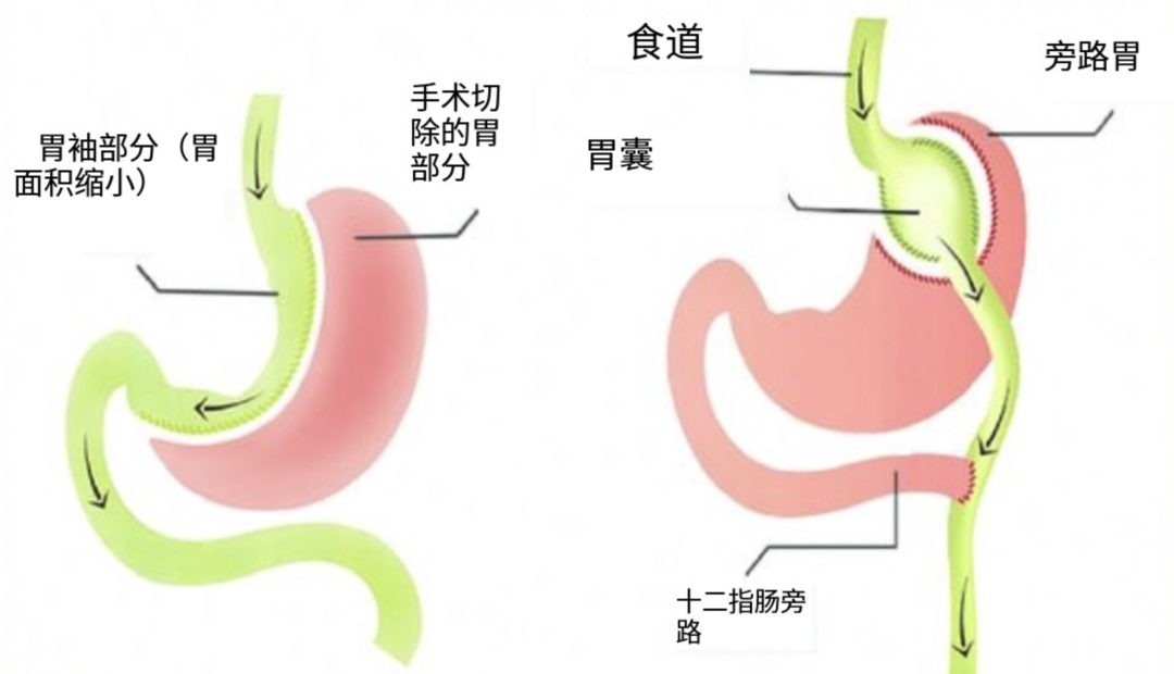 減肥手術哪種效果好_手術減肥_減肥手術多少錢