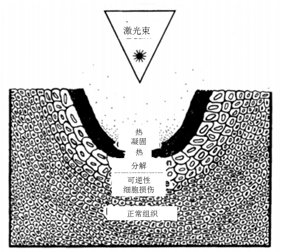 二氧化碳(co2)激光治疗是什么CO2激光手术后的伤口愈合研究_https://www.jmylbn.com_新闻资讯_第4张