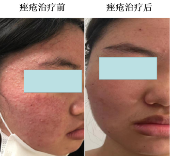 红光怎么治疗【健康科普】痘印？脱发？红光治疗了解一下！_https://www.jmylbn.com_新闻资讯_第4张