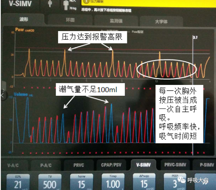 呼吸机压力怎么设置6呼吸机报警的设置+胸外心脏按压时的呼吸机设置_https://www.jmylbn.com_新闻资讯_第3张