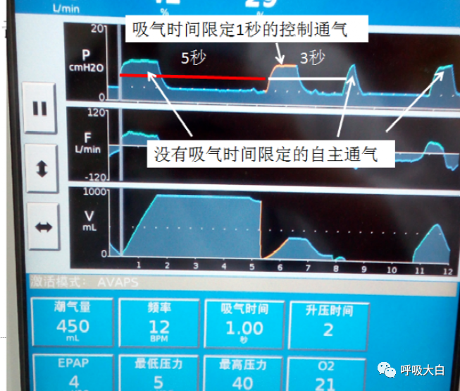 无创呼吸机怎么呼吸9常用无创呼吸机通气模式介绍+智能无创通气模式—AVAPS_https://www.jmylbn.com_新闻资讯_第4张