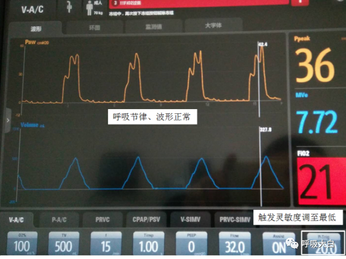 呼吸机压力怎么设置6呼吸机报警的设置+胸外心脏按压时的呼吸机设置_https://www.jmylbn.com_新闻资讯_第6张