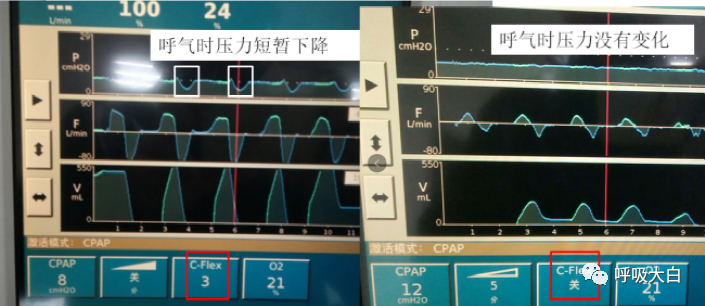 呼吸机压力怎么设置10无创呼吸机的次要参数+无创呼吸机的报警设置与错误触发_https://www.jmylbn.com_新闻资讯_第5张