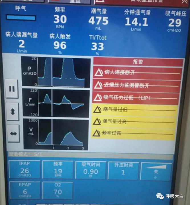 呼吸机的怎么调节全面了解无创通气模式和参数的设置_https://www.jmylbn.com_新闻资讯_第4张