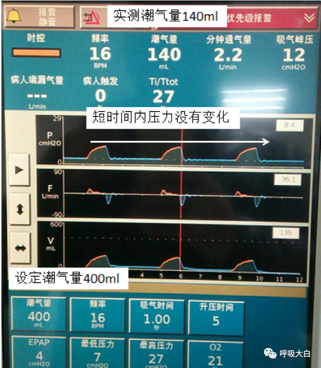 无创呼吸机怎么呼吸9常用无创呼吸机通气模式介绍+智能无创通气模式—AVAPS_https://www.jmylbn.com_新闻资讯_第11张