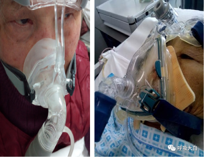 为什么呼吸机这么少8、无创通气的特点+无创呼吸机的特点_https://www.jmylbn.com_新闻资讯_第6张