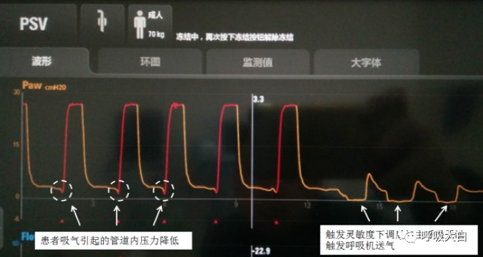 呼吸机压力怎么设置5、呼吸机的次要设置参数_https://www.jmylbn.com_新闻资讯_第3张