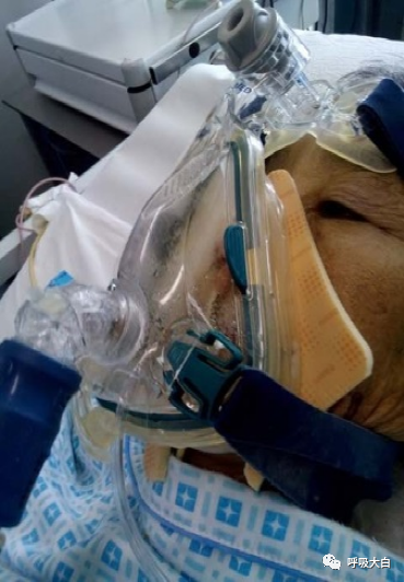 为什么呼吸机这么少8、无创通气的特点+无创呼吸机的特点_https://www.jmylbn.com_新闻资讯_第7张