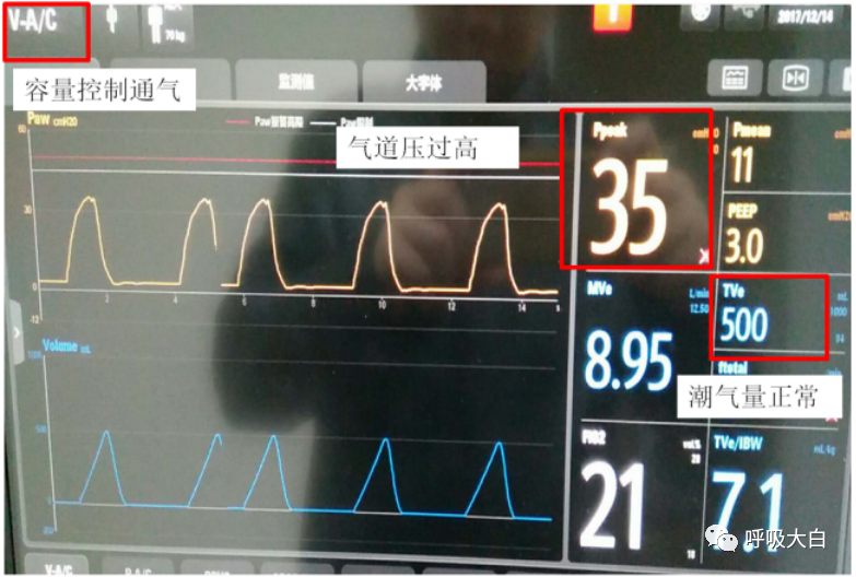 呼吸机呼吸怎么写学会呼吸机（呼吸机波形、通气模式、呼吸机设置、呼吸机报警、无创呼吸机、家用呼吸机）_https://www.jmylbn.com_新闻资讯_第13张