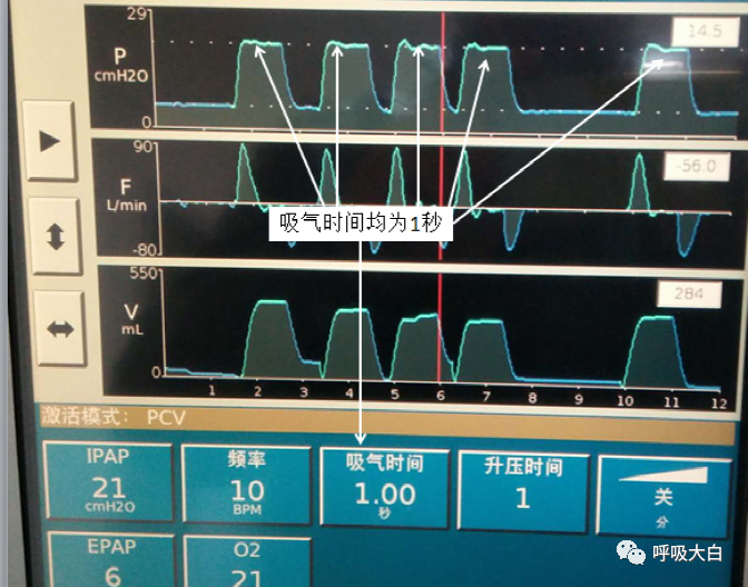 无创呼吸机怎么呼吸9常用无创呼吸机通气模式介绍+智能无创通气模式—AVAPS_https://www.jmylbn.com_新闻资讯_第7张