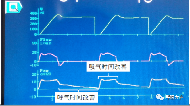 呼吸机呼气阀是什么11、家用无创呼吸机的特点_https://www.jmylbn.com_新闻资讯_第5张
