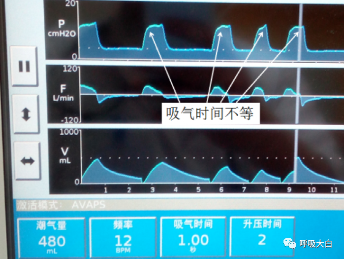 无创呼吸机怎么呼吸9常用无创呼吸机通气模式介绍+智能无创通气模式—AVAPS_https://www.jmylbn.com_新闻资讯_第10张