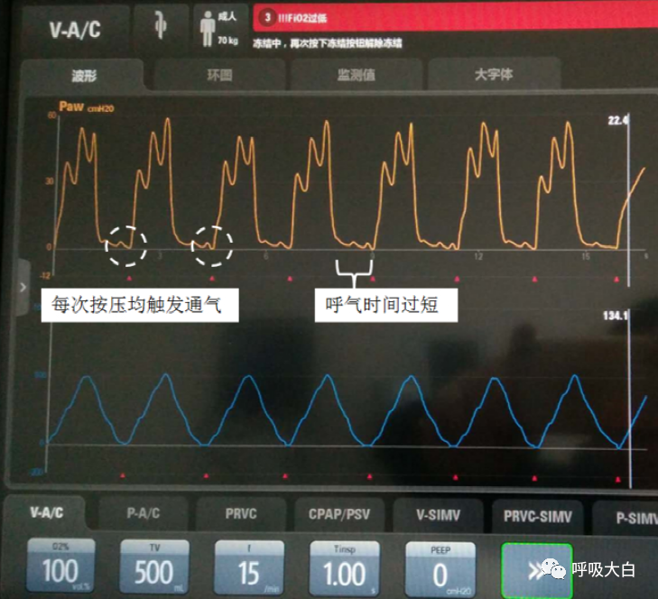 呼吸机压力怎么设置6呼吸机报警的设置+胸外心脏按压时的呼吸机设置_https://www.jmylbn.com_新闻资讯_第5张