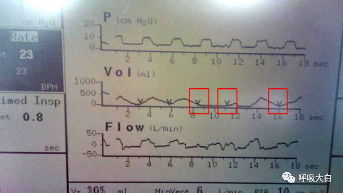 无创呼吸机怎么呼吸9常用无创呼吸机通气模式介绍+智能无创通气模式—AVAPS_https://www.jmylbn.com_新闻资讯_第5张