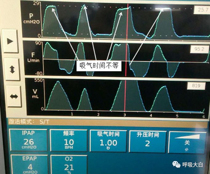无创呼吸机怎么呼吸9常用无创呼吸机通气模式介绍+智能无创通气模式—AVAPS_https://www.jmylbn.com_新闻资讯_第8张