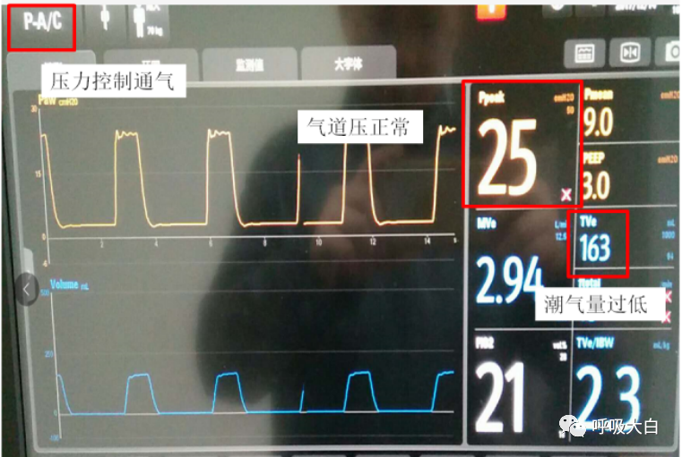 呼吸机呼吸怎么写学会呼吸机（呼吸机波形、通气模式、呼吸机设置、呼吸机报警、无创呼吸机、家用呼吸机）_https://www.jmylbn.com_新闻资讯_第14张
