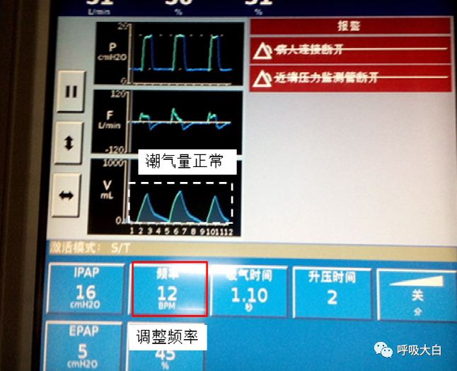 呼吸机压力怎么设置10无创呼吸机的次要参数+无创呼吸机的报警设置与错误触发_https://www.jmylbn.com_新闻资讯_第12张