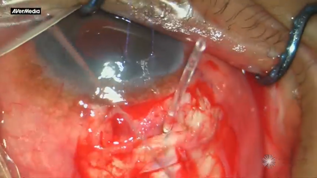 怎么装青光眼手术直击丨如何重新连接意外切断的青光眼引流装置管道（AGV）_https://www.jmylbn.com_新闻资讯_第1张