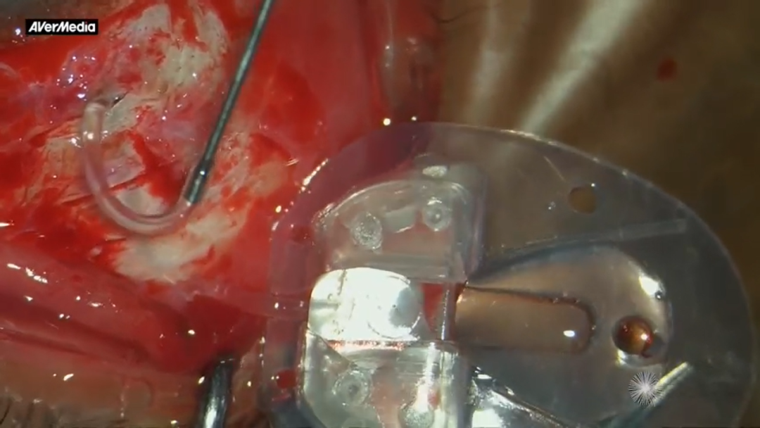 怎么装青光眼手术直击丨如何重新连接意外切断的青光眼引流装置管道（AGV）_https://www.jmylbn.com_新闻资讯_第4张