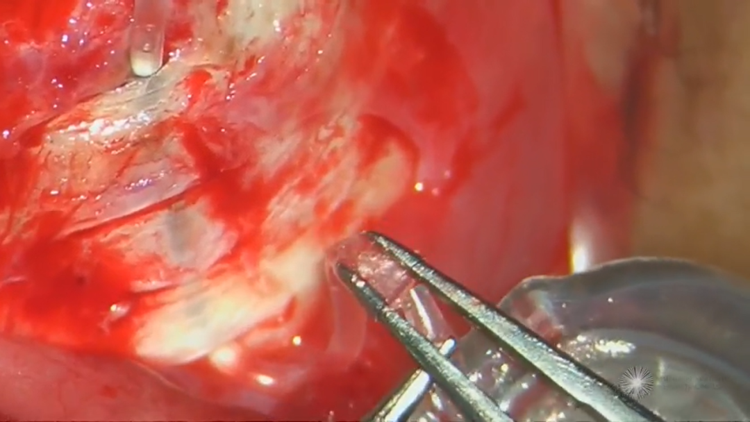 怎么装青光眼手术直击丨如何重新连接意外切断的青光眼引流装置管道（AGV）_https://www.jmylbn.com_新闻资讯_第3张