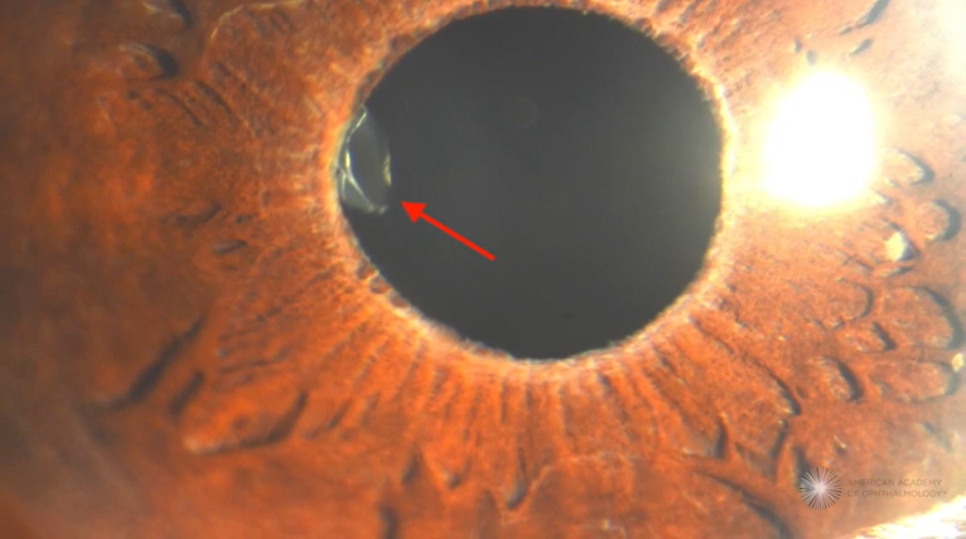 怎么装青光眼手术直击丨如何重新连接意外切断的青光眼引流装置管道（AGV）_https://www.jmylbn.com_新闻资讯_第5张