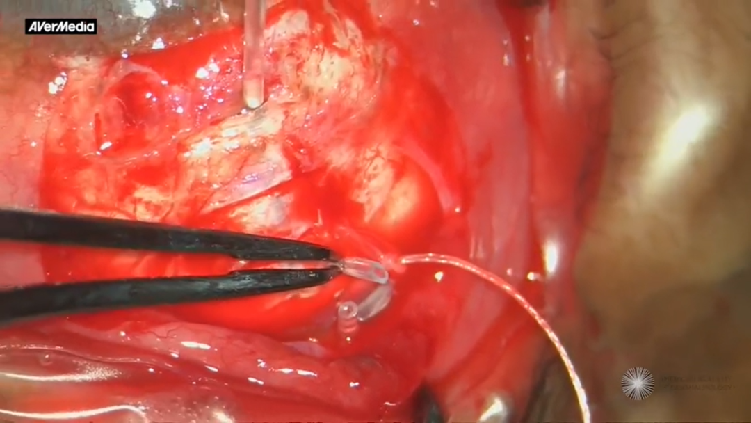 怎么装青光眼手术直击丨如何重新连接意外切断的青光眼引流装置管道（AGV）_https://www.jmylbn.com_新闻资讯_第2张