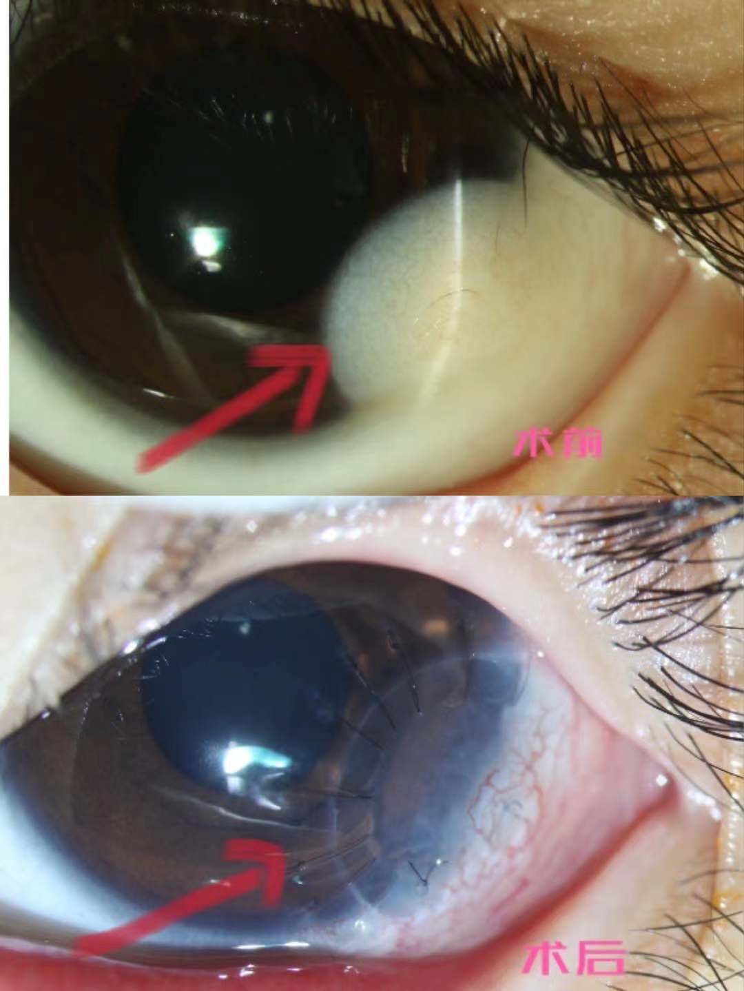 关注儿童眼健康 | 角膜皮样瘤是肿瘤吗?