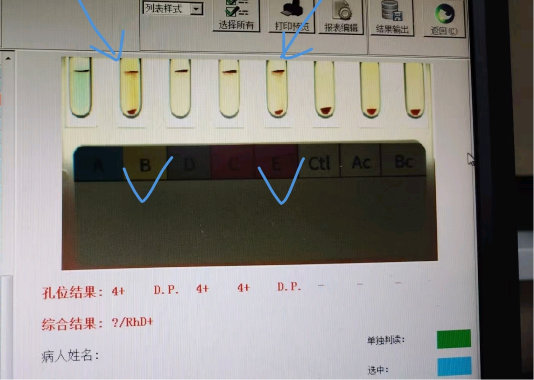 什么是双通道血球【健康科普】血型鉴定中神秘的“双群”现象-上海聚慕医疗器械有限公司