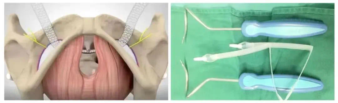 尿道张力过强怎么办【卓越医疗】解决患者难以启齿的漏尿尴尬——全县首例经闭孔尿道中段无张力悬吊术在我院妇科成功开展_https://www.jmylbn.com_新闻资讯_第12张
