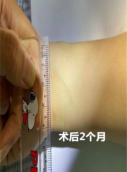 怎么买医用胶水【医疗服务】伤口无瘢技术---急诊医用胶术_https://www.jmylbn.com_新闻资讯_第6张