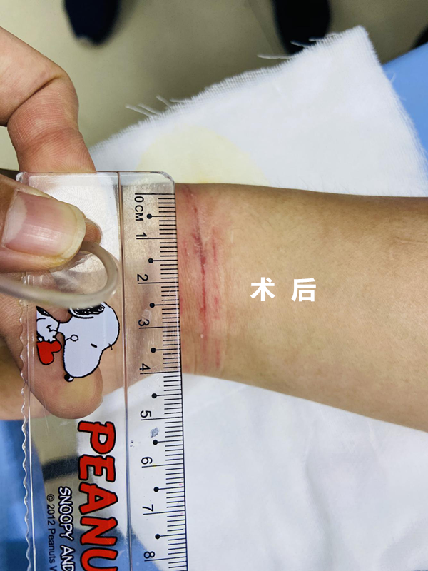 怎么买医用胶水【医疗服务】伤口无瘢技术---急诊医用胶术_https://www.jmylbn.com_新闻资讯_第5张