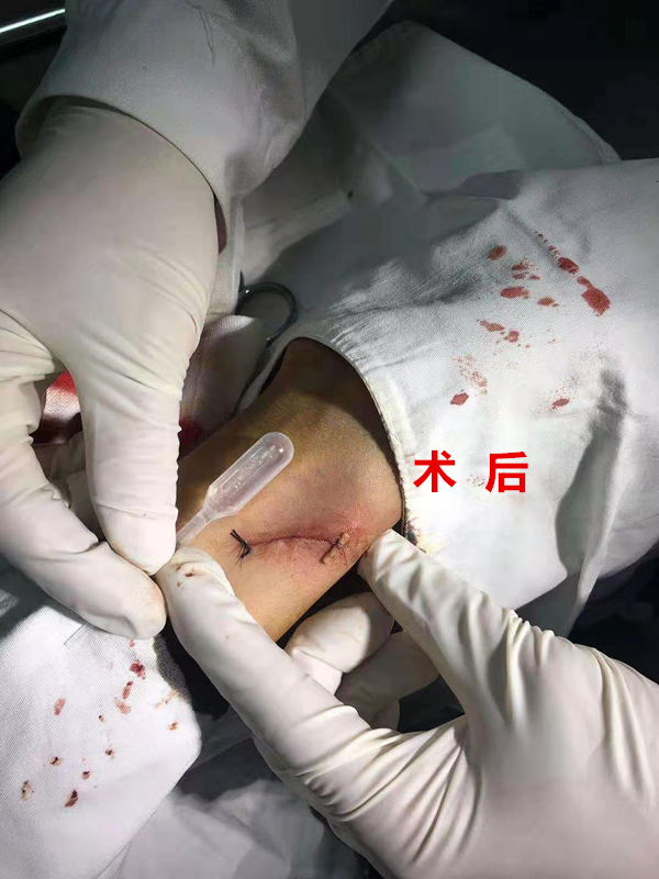 怎么买医用胶水【医疗服务】伤口无瘢技术---急诊医用胶术_https://www.jmylbn.com_新闻资讯_第10张