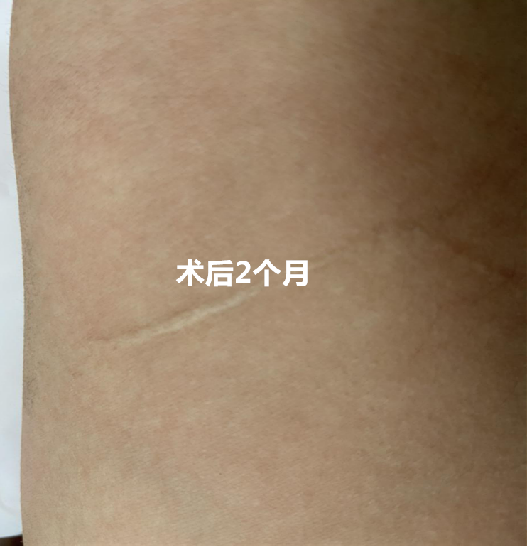 怎么买医用胶水【医疗服务】伤口无瘢技术---急诊医用胶术_https://www.jmylbn.com_新闻资讯_第13张