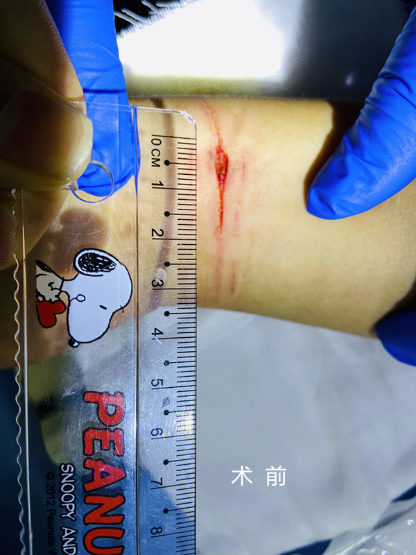 怎么买医用胶水【医疗服务】伤口无瘢技术---急诊医用胶术_https://www.jmylbn.com_新闻资讯_第4张