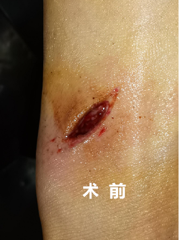 怎么买医用胶水【医疗服务】伤口无瘢技术---急诊医用胶术_https://www.jmylbn.com_新闻资讯_第7张