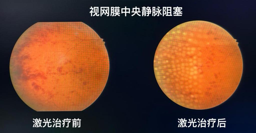 激光治疗仪能治什么病治疗“新利器”帮您打通眼底疾病的“任督二脉”_https://www.jmylbn.com_新闻资讯_第6张