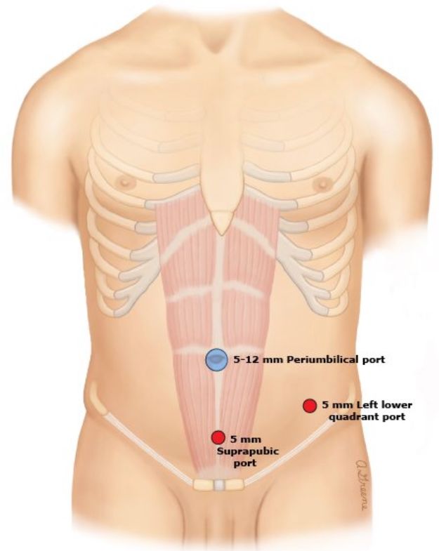 手术中怎么选择针腔镜手术中你知道怎么选择穿刺通道吗？_https://www.jmylbn.com_新闻资讯_第8张