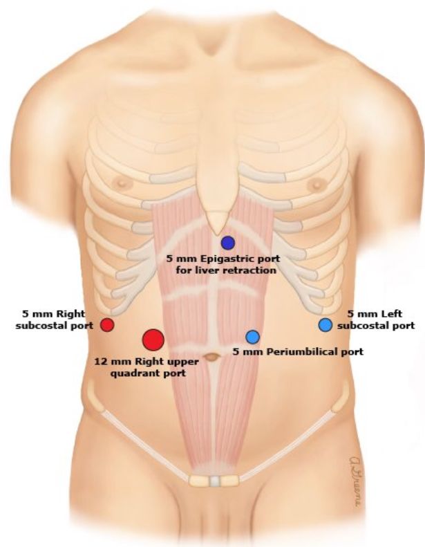 手术中怎么选择针腔镜手术中你知道怎么选择穿刺通道吗？_https://www.jmylbn.com_新闻资讯_第7张