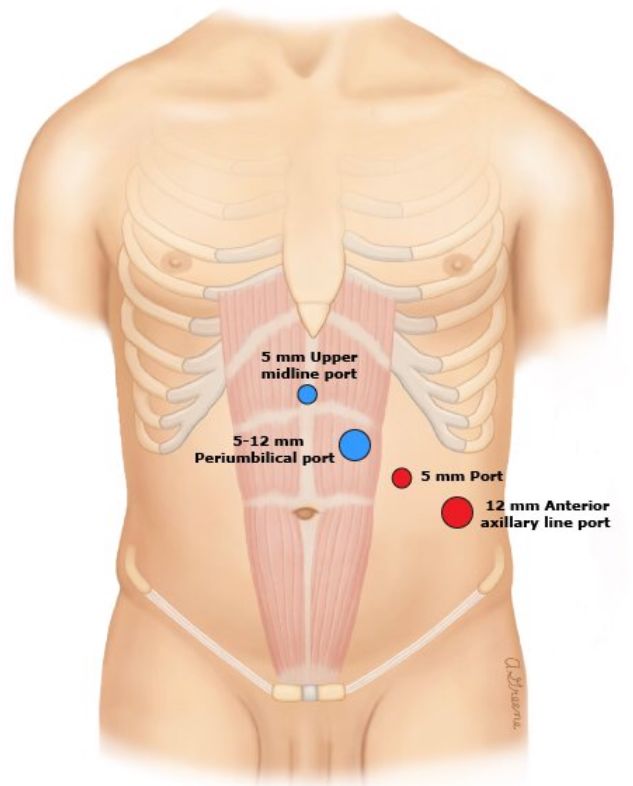 手术中怎么选择针腔镜手术中你知道怎么选择穿刺通道吗？_https://www.jmylbn.com_新闻资讯_第11张