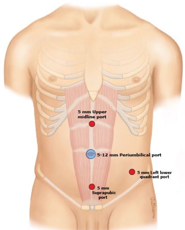 手术中怎么选择针腔镜手术中你知道怎么选择穿刺通道吗？_https://www.jmylbn.com_新闻资讯_第9张
