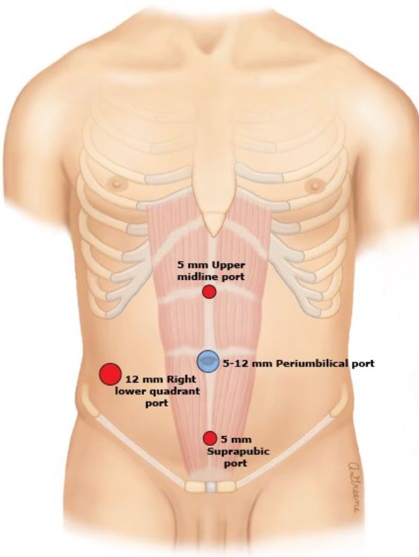 手术中怎么选择针腔镜手术中你知道怎么选择穿刺通道吗？_https://www.jmylbn.com_新闻资讯_第10张