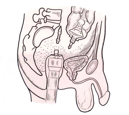 肠道吻合器是什么材质吻合技巧 ｜ 消化道吻合_https://www.jmylbn.com_新闻资讯_第26张