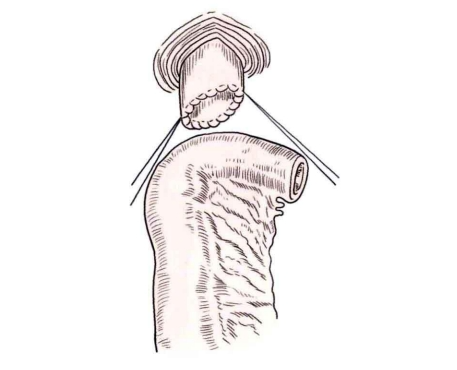 肠道吻合器是什么材质吻合技巧 ｜ 消化道吻合_https://www.jmylbn.com_新闻资讯_第7张