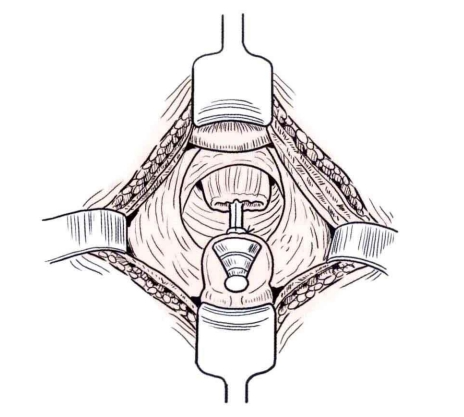 肠道吻合器是什么材质吻合技巧 ｜ 消化道吻合_https://www.jmylbn.com_新闻资讯_第27张