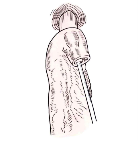 端端吻合器是什么消化道吻合技巧_https://www.jmylbn.com_新闻资讯_第9张