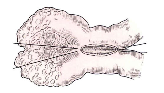 端端吻合器是什么消化道吻合技巧_https://www.jmylbn.com_新闻资讯_第21张